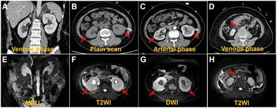 Untypical bilateral breast cancer with peritoneal fibrosis on 18F-FDG PET/CT: case report and literature review